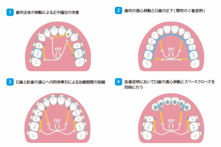 ﾊﾟﾗﾀﾙﾚﾊﾞｰｱｰﾑｼｽﾃﾑ PLAS X 1.2mm