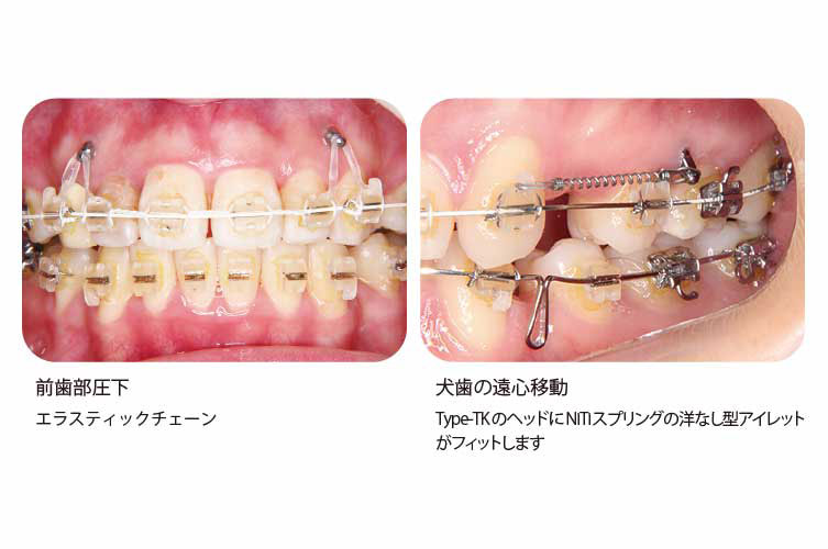 B-max ｽｸﾘｭｰ Type-TK # φ1.6×8mm