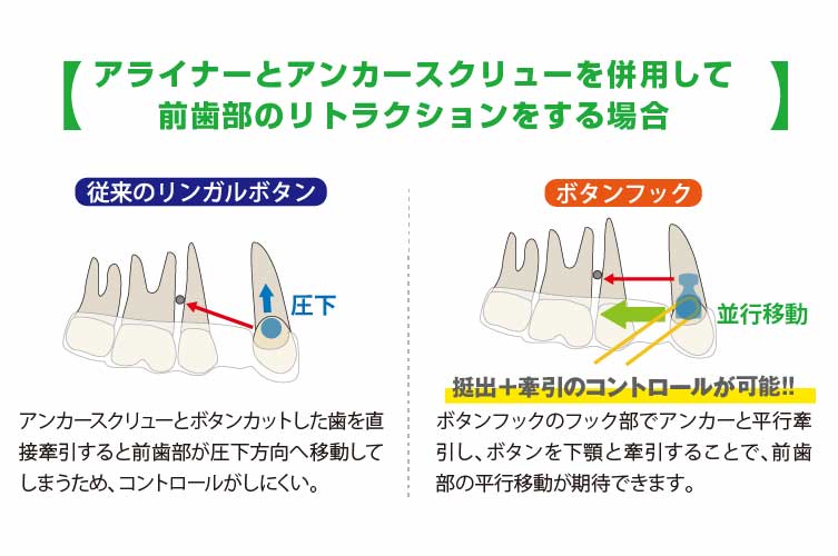 ECCｱﾀｯﾁﾒﾝﾄ II ﾎﾞﾀﾝﾌｯｸ(10入)